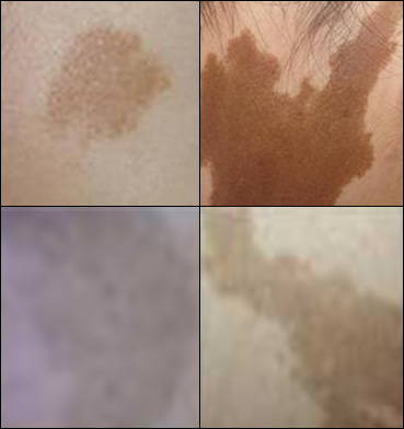 <strong>宝宝咖啡斑什么时候去除更好？南京市哪家胎记医院好？</strong>