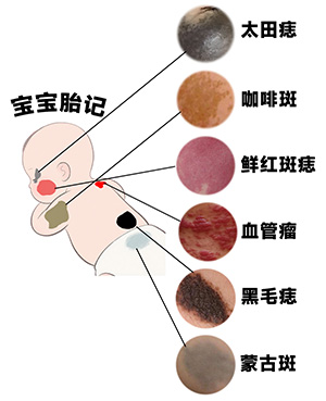 <strong>宝宝胎记会自己消失吗？南京能去除胎记的医院哪家好？</strong>