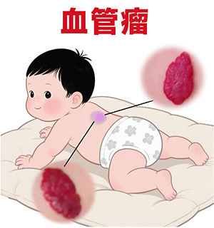 <strong>宝妈必看-血管瘤胎记长在这些部位要特别注意？</strong>