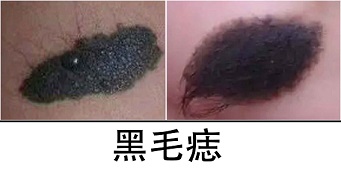 <strong>胎记答疑·黑毛痣毛发脱落且边缘发红——这是恶变前兆吗？</strong>