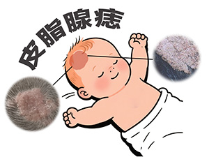 <strong>胎记速览-皮脂腺痣到底是什么？它会造成哪些影响？</strong>