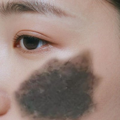 <strong>新闻资讯：咖啡斑对身体有什么危害？</strong>