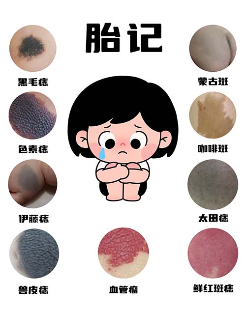 <strong>宝宝胎记几岁治疗合适？南京胎记医院哪里好？</strong>