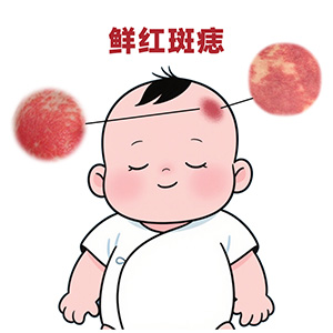 <strong>鲜红斑痣一般几岁消退？南京胎记医院哪家好？</strong>