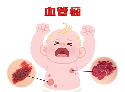 <strong>怎么判断是不是血管瘤？南京胎记医院哪家好？</strong>