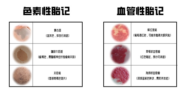 <strong>哎呀！孩子胎记还在长？这几种情况要注意！</strong>
