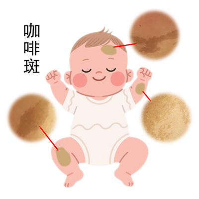 <strong>咖啡斑遗传？真相竟然是...</strong>