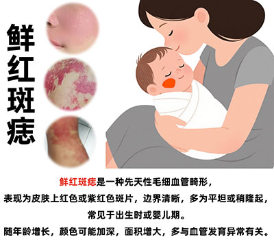 <strong>鲜红斑痣的5大误区，90%的人都踩过坑！</strong>