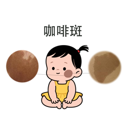 <strong>皮肤科普丨咖啡斑治疗后复发与饮食有关吗？需避开深色食物吗？</strong>