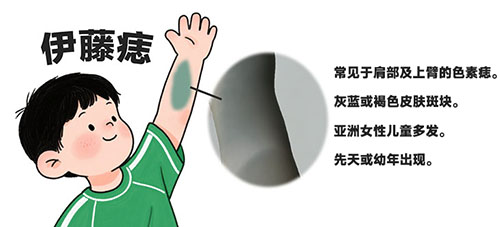 <strong>伊藤痣饮食禁忌有哪些？南京哪个医院看胎记比较好？</strong>