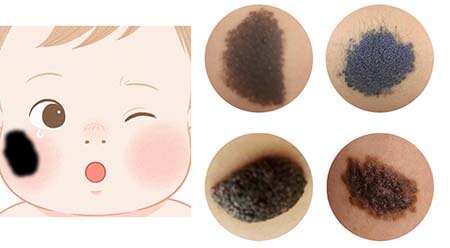 <strong>健康科普丨黑毛痣的面积大小影响治疗吗？多大面积需要手术？</strong>