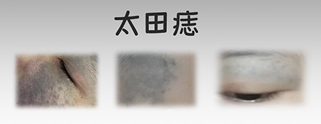 <strong>太田痣需警惕的 3 种眼部并发症，家长必看！</strong>