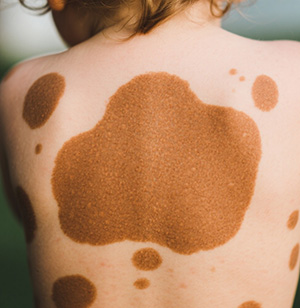 <strong>咖啡斑会持续增多吗？如何控制其发展？</strong>