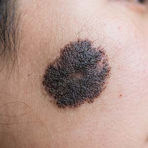 <strong>家长必看：黑毛痣直径超过6毫米危险吗？需要手术切除吗？</strong>