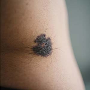 <strong>胎记知识：黑毛痣治疗费用多少？按面积怎么收费？</strong>