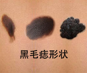 <strong>【胎记探秘】黑毛痣患者日常保护的7个注意事项</strong>