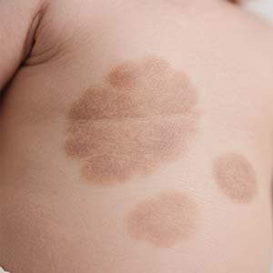 <strong>胎记阐释·咖啡斑会随孩子长大吗？数量会增加吗？</strong>