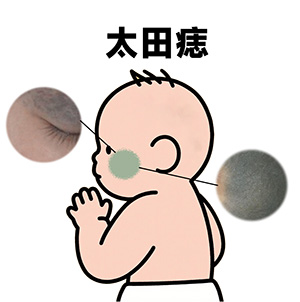 <strong>健康常识丨太田痣颜色多是青褐色吗？会影响眼周皮肤吗？</strong>
