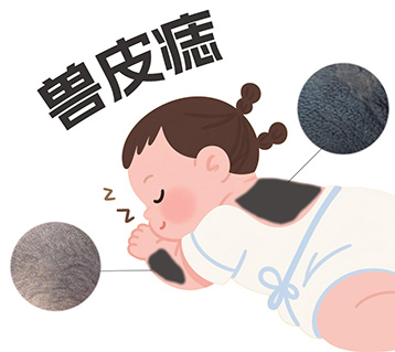 <strong>胎记解惑丨兽皮痣对身体有影响吗？有什么危害？</strong>