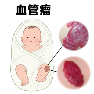 <strong>胎记认知丨血管瘤不治疗会自行消退吗？哪些情况需治疗？</strong>