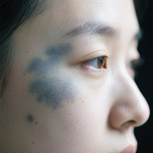 <strong>皮肤知识·太田痣治疗费用多少？影响因素有哪些？</strong>