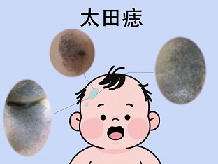<strong>孩子太田痣越长越大，该怎么办？</strong>