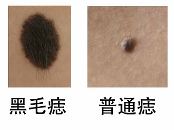 <strong>黑毛痣与普通黑痣的区别？3步辨别法</strong>