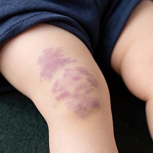 <strong>疾病科普·孩子胎记越长越大？警惕这几种危险信号！</strong>