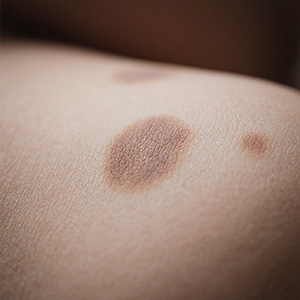 <strong>【医生答疑】咖啡斑为什么越治越深？可能是方法不对...</strong>