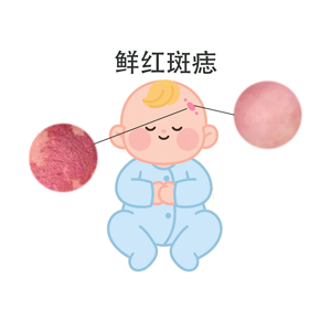 <strong>【专家解读】鲜红斑痣治疗黄金年龄？越小越好吗？</strong>