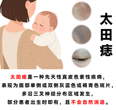 <strong>【太田痣会遗传吗？】从临床大数据看遗传概率与规律</strong>