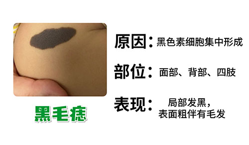 <strong>黑毛痣会遗传给下一代吗？南京胎记哪个医院好？</strong>