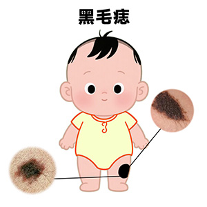 带毛的黑痣有去除的必要吗？什么情况需要去除？