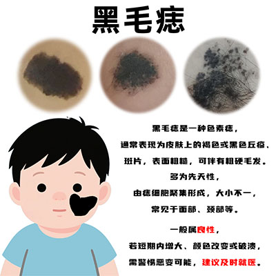 黑毛痣的影响大吗？南京治黑毛痣专科医院哪家好？